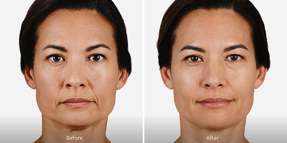 Injectables Before After